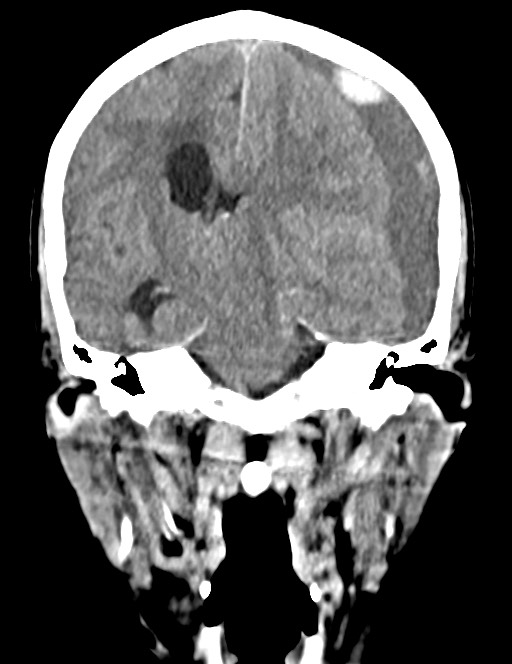 Acute on chronic subdural hematoma (Radiopaedia 74814-85823 Coronal non-contrast 36).jpg