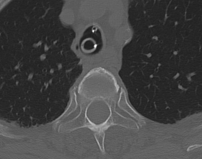 Acute on chronic subdural hematoma and thoracic vertebral injury in a multitrauma patient (Radiopaedia 31698-32619 Axial bone window 72).jpg