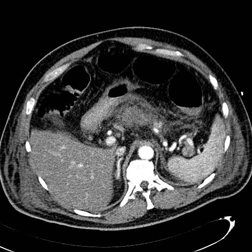 File:Acute pancreatic necrosis (Radiopaedia 13560-13486 Axial C+ portal venous phase 44).jpg