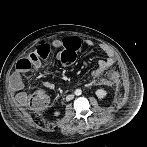File:Acute pancreatic necrosis (Radiopaedia 13560-18501 Axial C+ portal venous phase 78).jpg