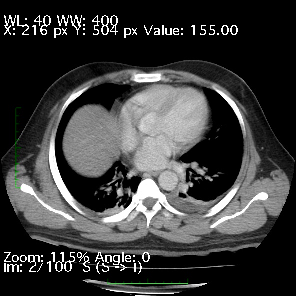 Acute pancreatitis (Radiopaedia 34043-35276 Axial C+ portal venous phase 2).jpg
