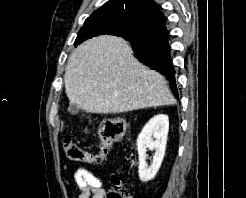 Acute pancreatitis (Radiopaedia 85146-100701 Sagittal C+ portal venous phase 18).jpg