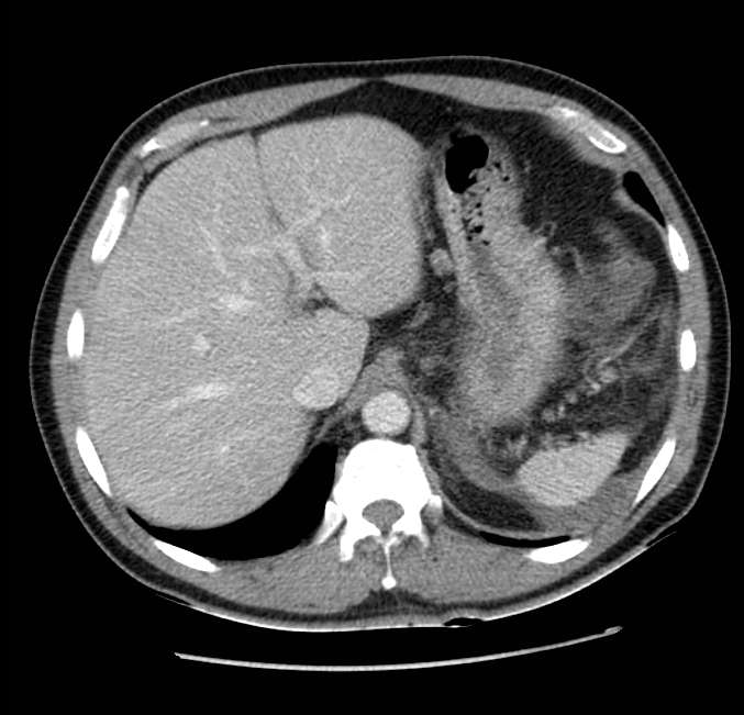 Acute pancreatitis - Balthazar E (Radiopaedia 23080-23110 Axial C+ portal venous phase 14).jpg