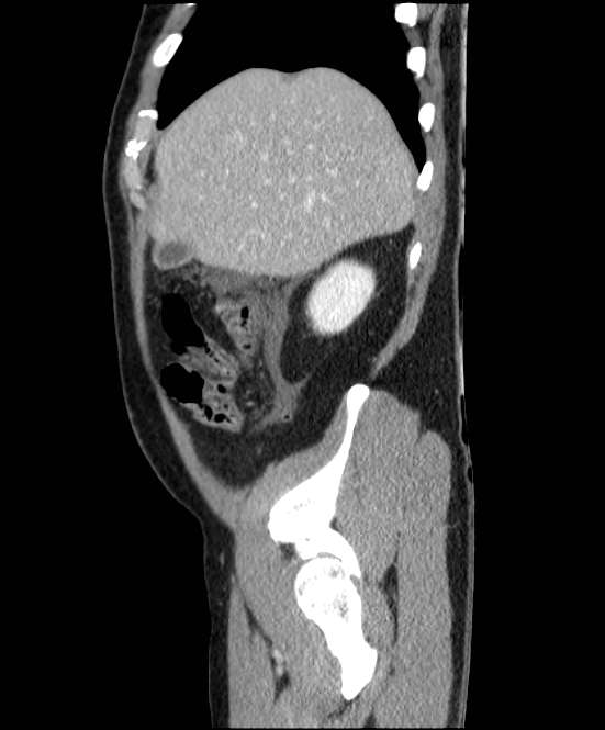 Acute pancreatitis - Balthazar E (Radiopaedia 23080-23110 Sagittal C+ portal venous phase 15).jpg