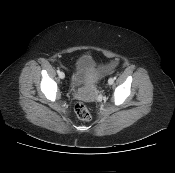 Acute pancreatitis - Balthazar E (Radiopaedia 29016-29377 Axial C+ portal venous phase 66).png