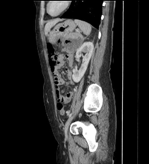 Acute pancreatitis - Balthazar E - post ERCP (Radiopaedia 27562-27772 Sagittal C+ portal venous phase 96).png
