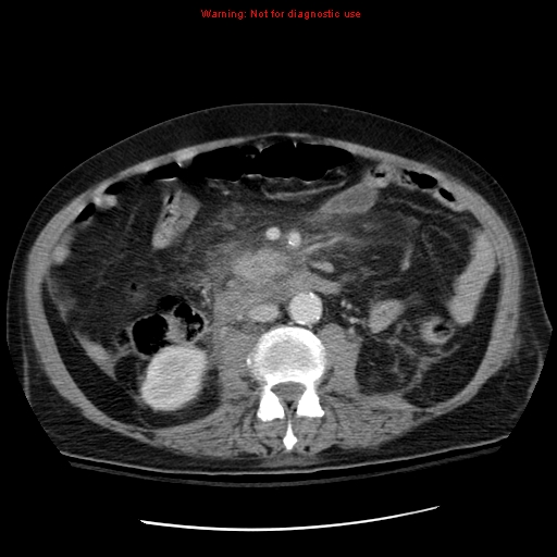 File:Acute pancreatitis with incidental pancreatic lipoma (Radiopaedia 10190-10730 Axial C+ portal venous phase 37).jpg