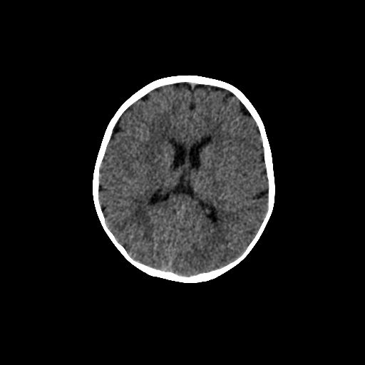 Acute phase of hemiconvulsion-hemiplegia epilepsy syndrome (Radiopaedia 29309-29744 Axial non-contrast 22).jpg