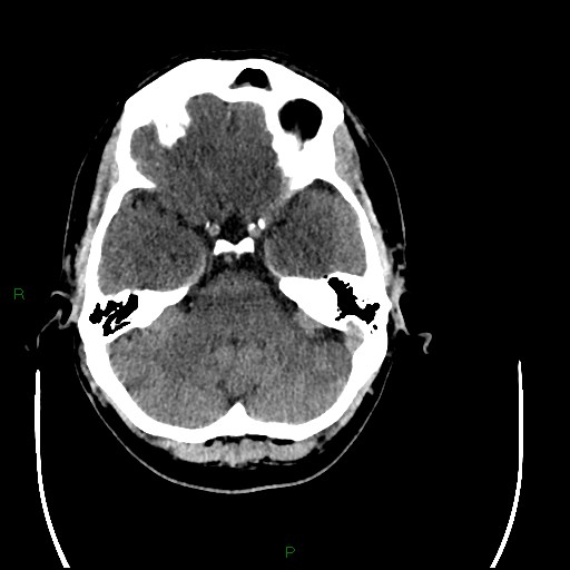 Acute posterior cerebral artery territory infarct (Radiopaedia 79329-92393 Axial non-contrast 28).jpg