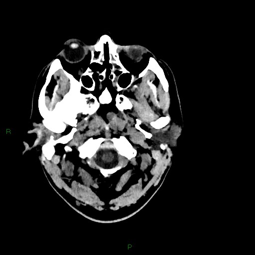 Acute posterior cerebral artery territory infarct (Radiopaedia 79329-92393 Axial non-contrast 9).jpg
