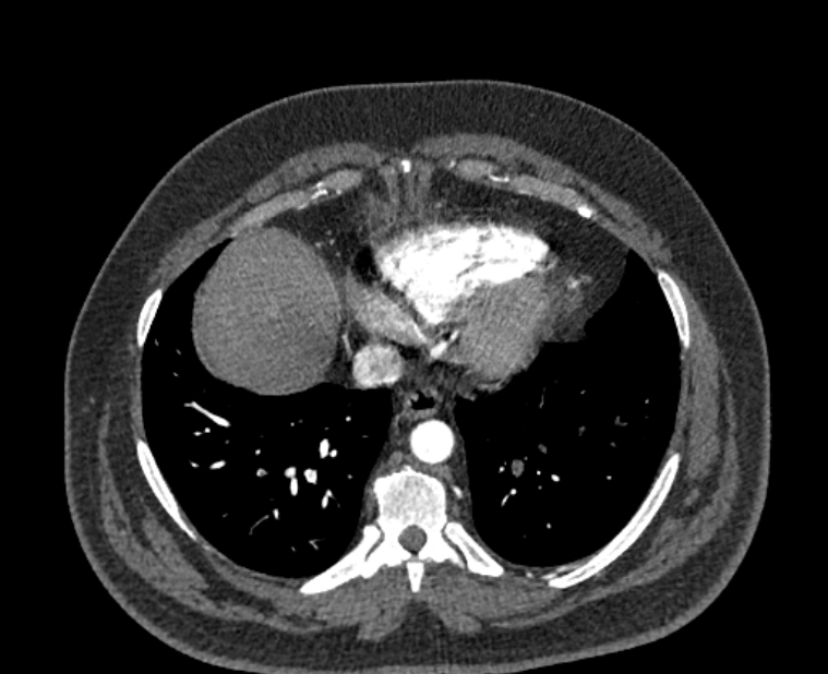 Acute pulmonary embolism with pulmonary infarcts (Radiopaedia 77688-89908 Axial C+ CTPA 50).jpg