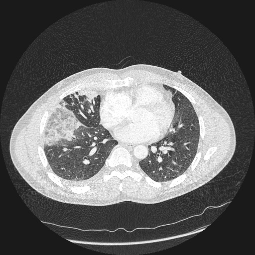 Acute segmental pulmonary emboli and pulmonary infarction (Radiopaedia 62264-70444 Axial lung window 117).jpg