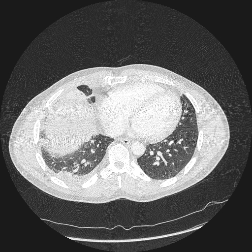 Acute segmental pulmonary emboli and pulmonary infarction (Radiopaedia 62264-70444 Axial lung window 134).jpg