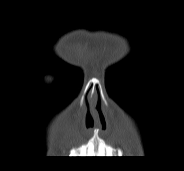 File:Acute sinusitis (Radiopaedia 23161-23215 Coronal bone window 17).jpg