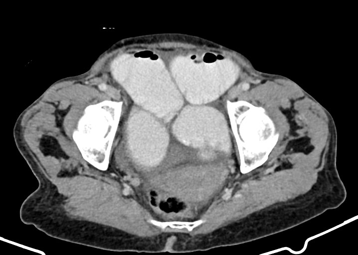 Acute small bowel (ileal) volvulus (Radiopaedia 71740-82139 Axial C+ portal venous phase 178).jpg