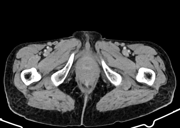Acute small bowel (ileal) volvulus (Radiopaedia 71740-82139 Axial C+ portal venous phase 215).jpg