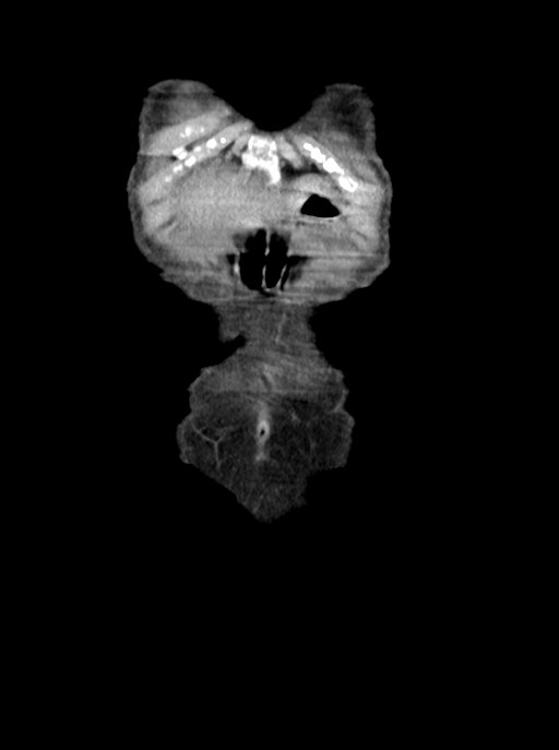 Acute small bowel (ileal) volvulus (Radiopaedia 71740-82139 Coronal C+ portal venous phase 8).jpg