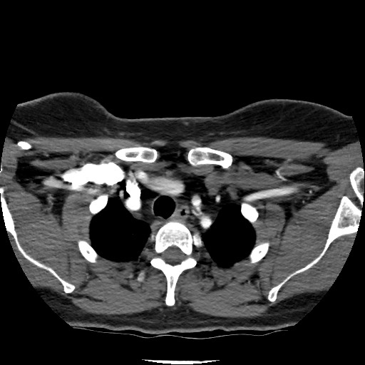 Acute subarachnoid hemorrhage and accessory anterior cerebral artery (Radiopaedia 69231-79009 Axial C+ arterial phase 23).jpg
