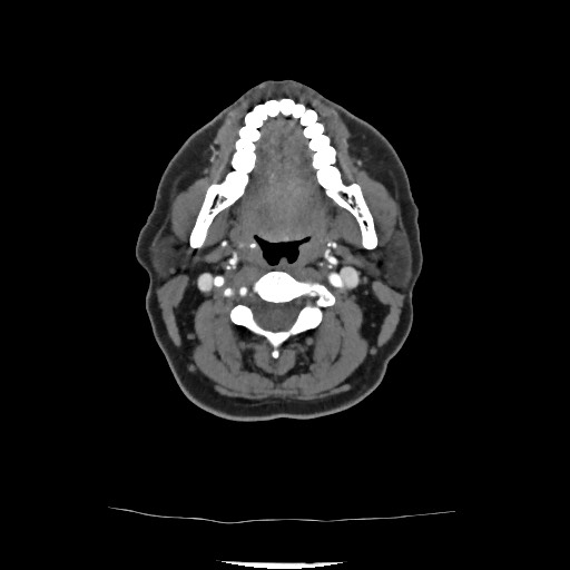 Acute subarachnoid hemorrhage and accessory anterior cerebral artery (Radiopaedia 69231-79009 Axial C+ arterial phase 61).jpg