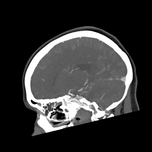 Acute subarachnoid hemorrhage and accessory anterior cerebral artery (Radiopaedia 69231-79009 Sagittal C+ arterial phase 44).jpg