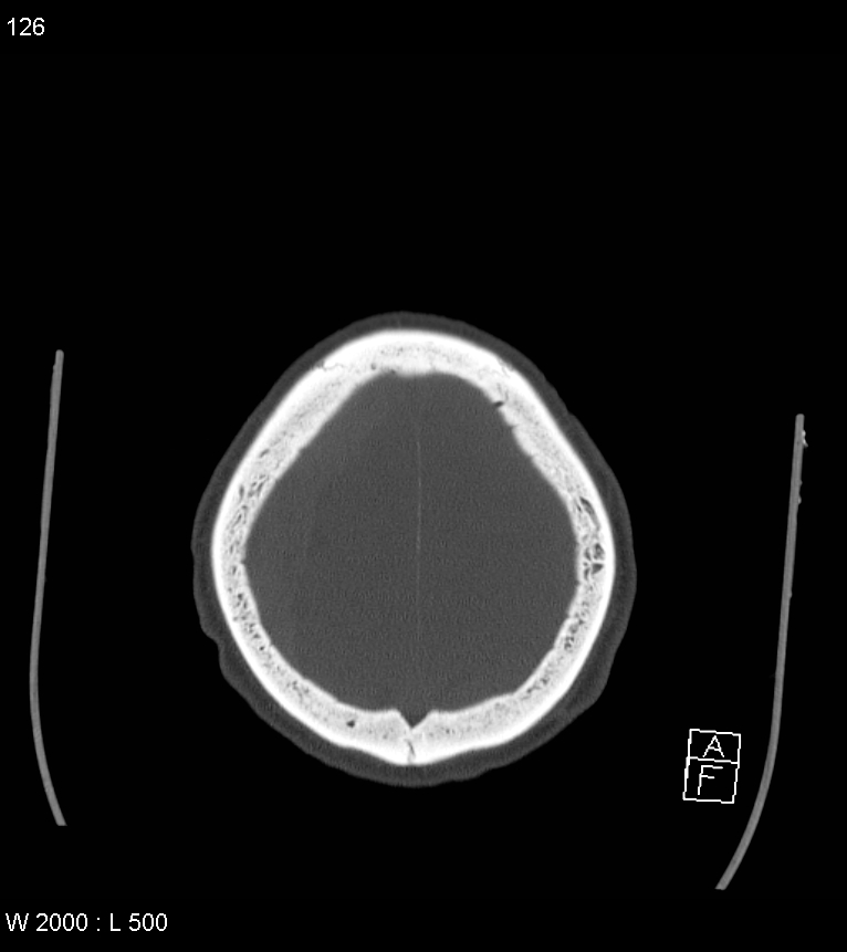 Acute subdural hematoma with myelofibrosis (Radiopaedia 52582-58494 Axial bone window 63).jpg