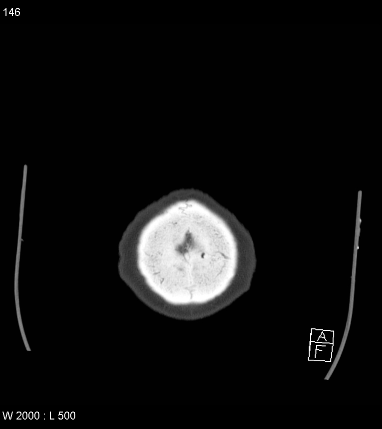 Acute subdural hematoma with myelofibrosis (Radiopaedia 52582-58494 Axial bone window 73).jpg