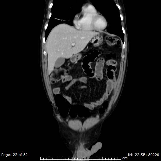 Acute superior mesenteric artery occlusion (Radiopaedia 43636-47060 Coronal C+ portal venous phase 7).jpg