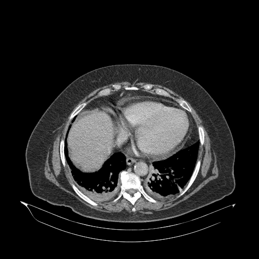 File:Acute superior mesenteric artery occlusion (Radiopaedia 51288-56960 Axial C+ portal venous phase 7).jpg