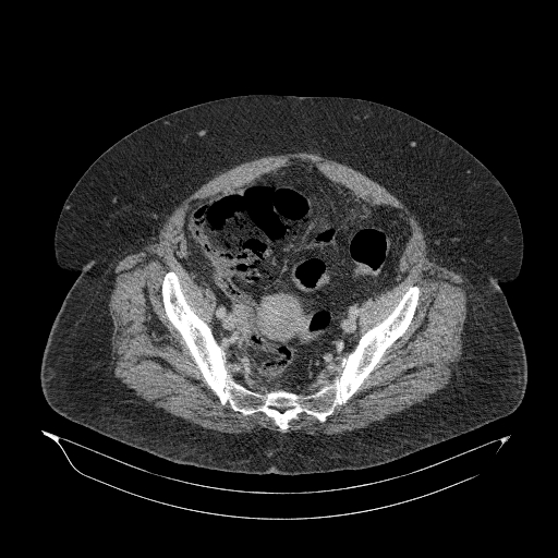 File:Acute superior mesenteric artery occlusion (Radiopaedia 51288-56960 Axial C+ portal venous phase 83).jpg