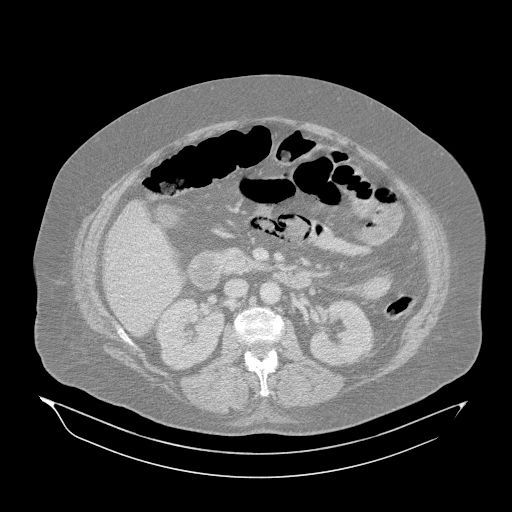 Acute superior mesenteric artery occlusion (Radiopaedia 51288-56960 Axial lung window 21).jpg