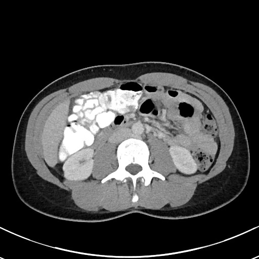 File:Acute uncomplicated appendicitis (Radiopaedia 61374-69304 Axial 45).jpg