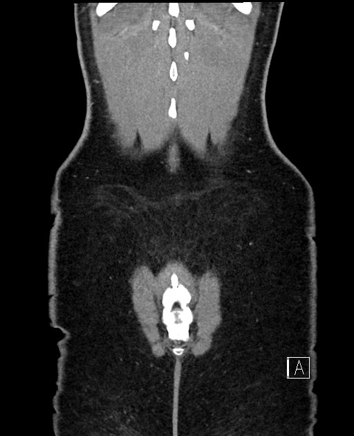Acute uncomplicated appendicitis (Radiopaedia 61374-69304 Coronal C+ portal venous phase 100).jpg