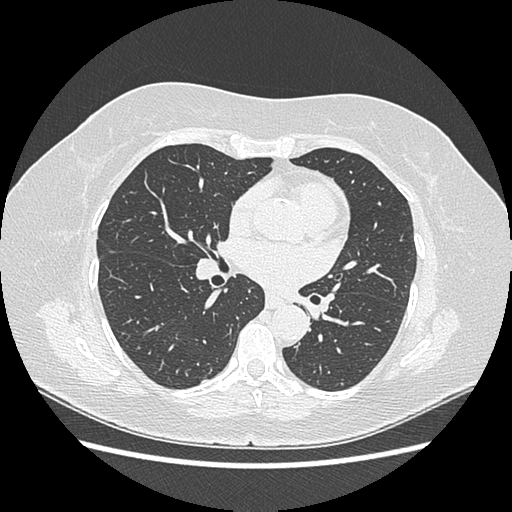 Adenocarcinoma in situ of lung (Radiopaedia 38685-40829 B 120).png