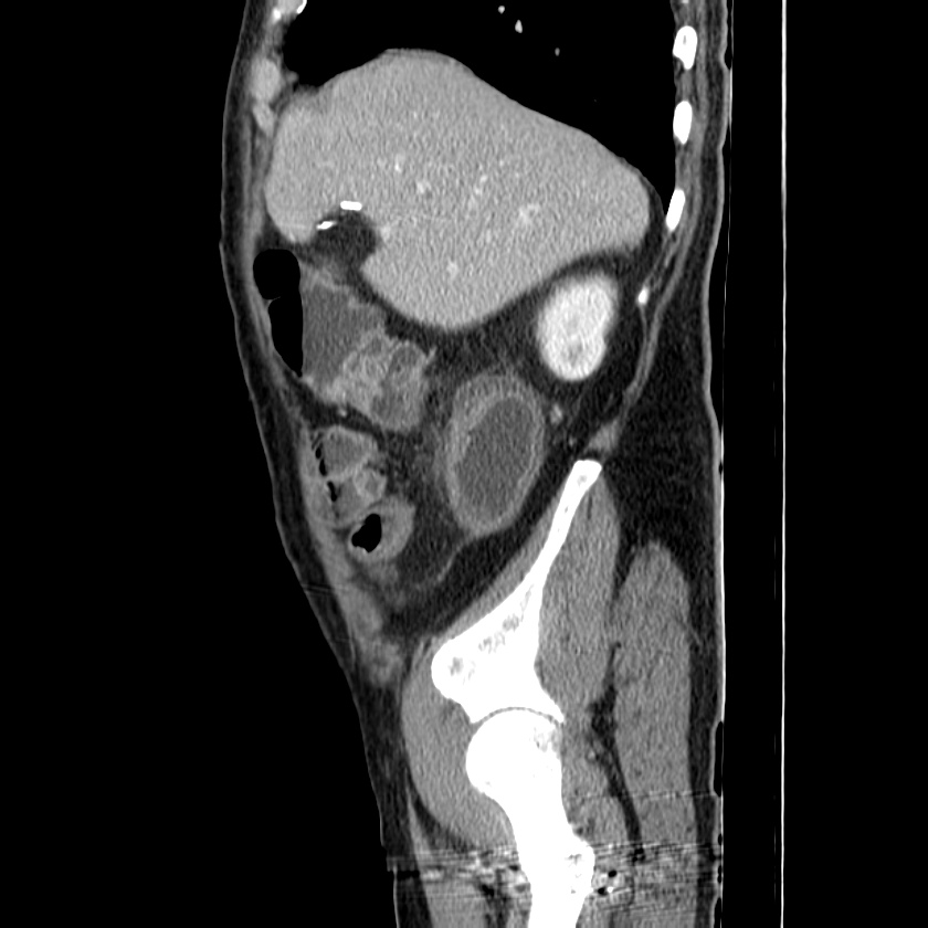 Adenocarcinoma of colon with entero-colic fistula (Radiopaedia 22832-22852 Sagittal C+ portal venous phase 14).jpg