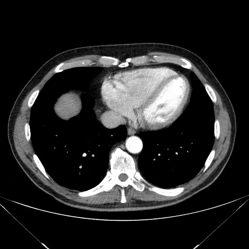 Adenocarcinoma of the lung (Radiopaedia 59871-67325 Axial C+ arterial phase 70).jpg