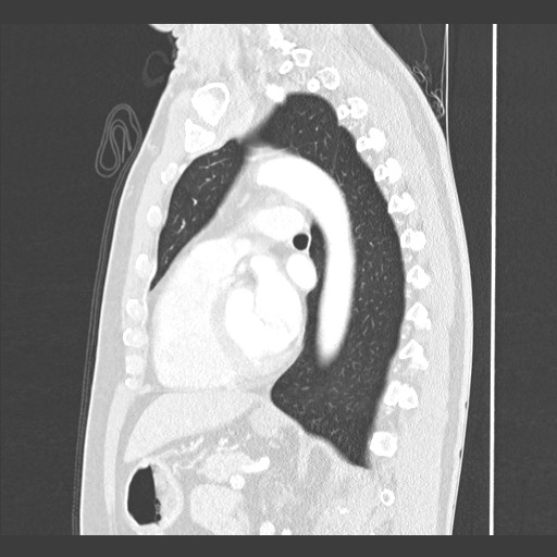 Adenocarcinoma of the lung (Radiopaedia 59871-67325 Sagittal lung window 61).jpg