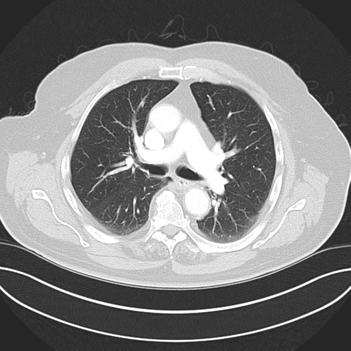 Adenocarcioma of rectum- T1 lesion (Radiopaedia 36921-38547 Axial lung window 25).png