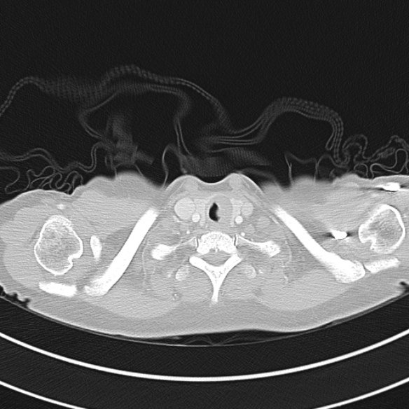 Adenocystic carcinoma of the trachea (Radiopaedia 47677-52525 Axial lung window 28).jpg