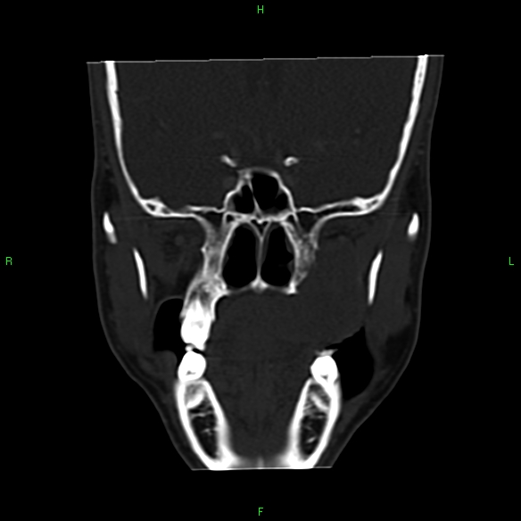 File:Adenoid cystic carcinoma of hard palate (Radiopaedia 26137-26273 Coronal bone window 14).jpg