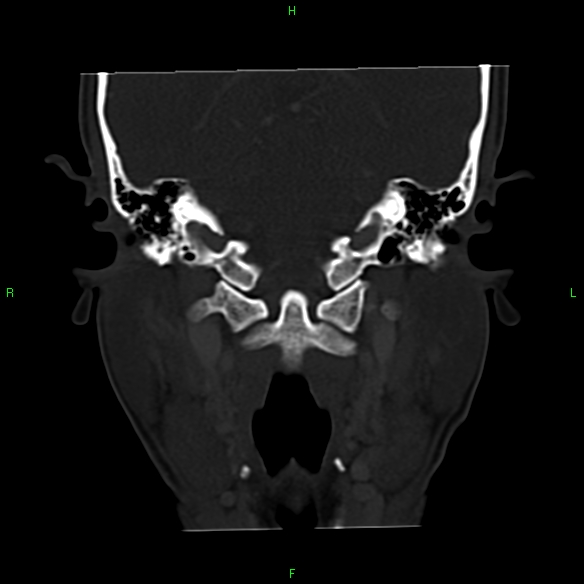 File:Adenoid cystic carcinoma of hard palate (Radiopaedia 26137-26273 Coronal bone window 25).jpg