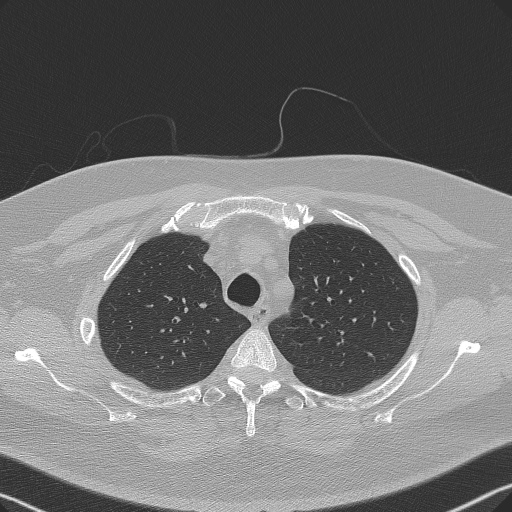 Adenoid cystic carcinoma of the trachea (Radiopaedia 49042-54137 Axial lung window 76).jpg