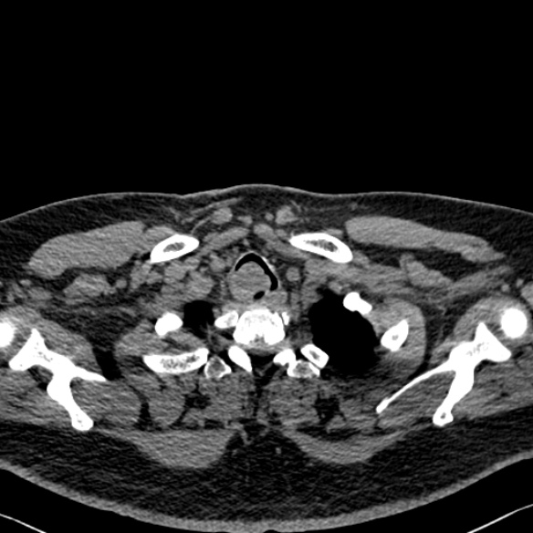 Adenoid cystic carcinoma of the trachea (Radiopaedia 49042-54137 Axial non-contrast 24).jpg