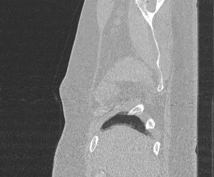 Adenoid cystic carcinoma of the trachea (Radiopaedia 49042-54137 Sagittal lung window 35).jpg
