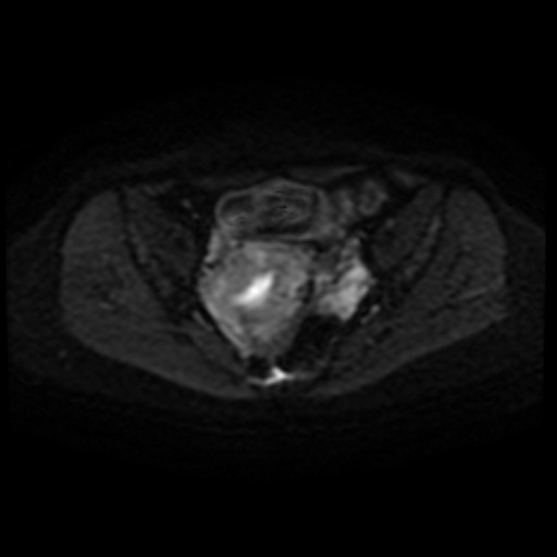 Adenoma malignum of cervix (Radiopaedia 66441-75705 Axial DWI 34).jpg