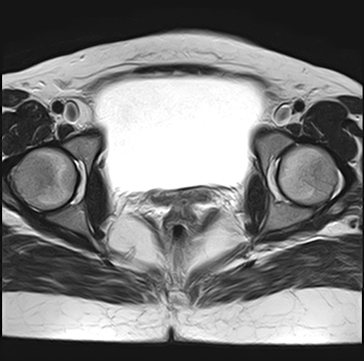 File:Adenomyosis - ovarian endometriomas (Radiopaedia 67031-76350 Axial T2 21).jpg