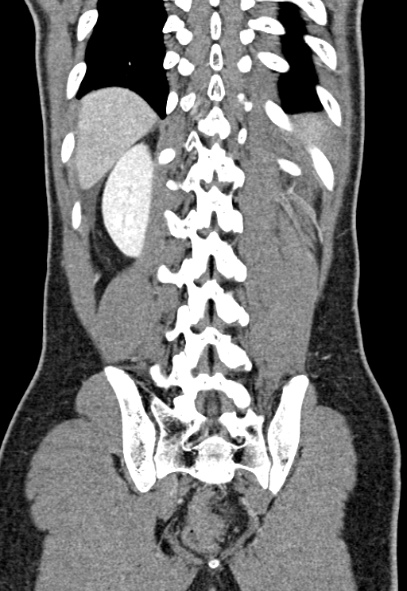 Adhesional small bowel obstruction (Radiopaedia 52107-57980 Coronal C+ portal venous phase 67).jpg