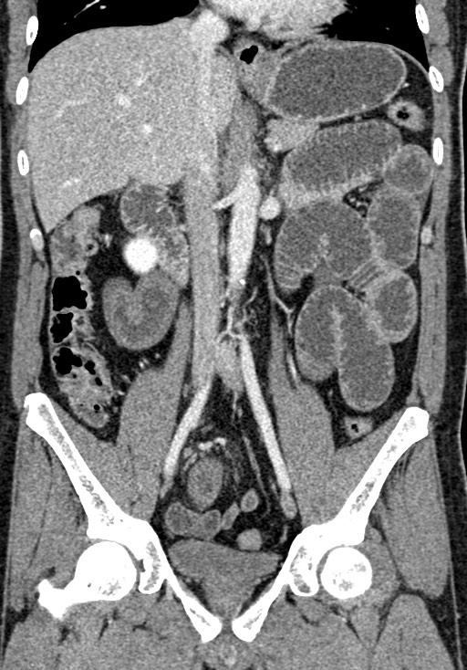 Adhesional small bowel obstruction (Radiopaedia 58900-66131 Coronal C+ portal venous phase 143).jpg