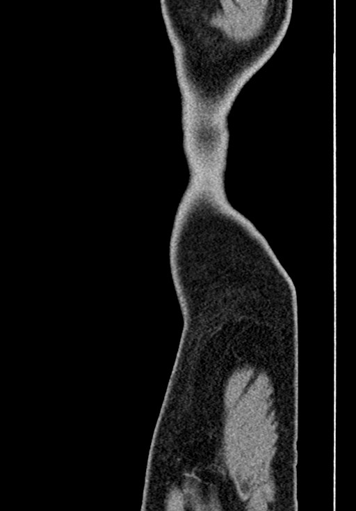 Adhesional small bowel obstruction (Radiopaedia 58900-66131 Sagittal C+ portal venous phase 1).jpg