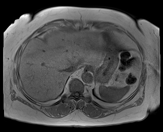 File:Adrenal cortical carcinoma (Radiopaedia 64017-72770 Axial T1 in-phase 8).jpg
