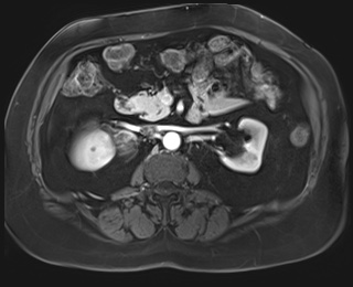 File:Adrenal cortical carcinoma (Radiopaedia 64017-72770 I 43).jpg